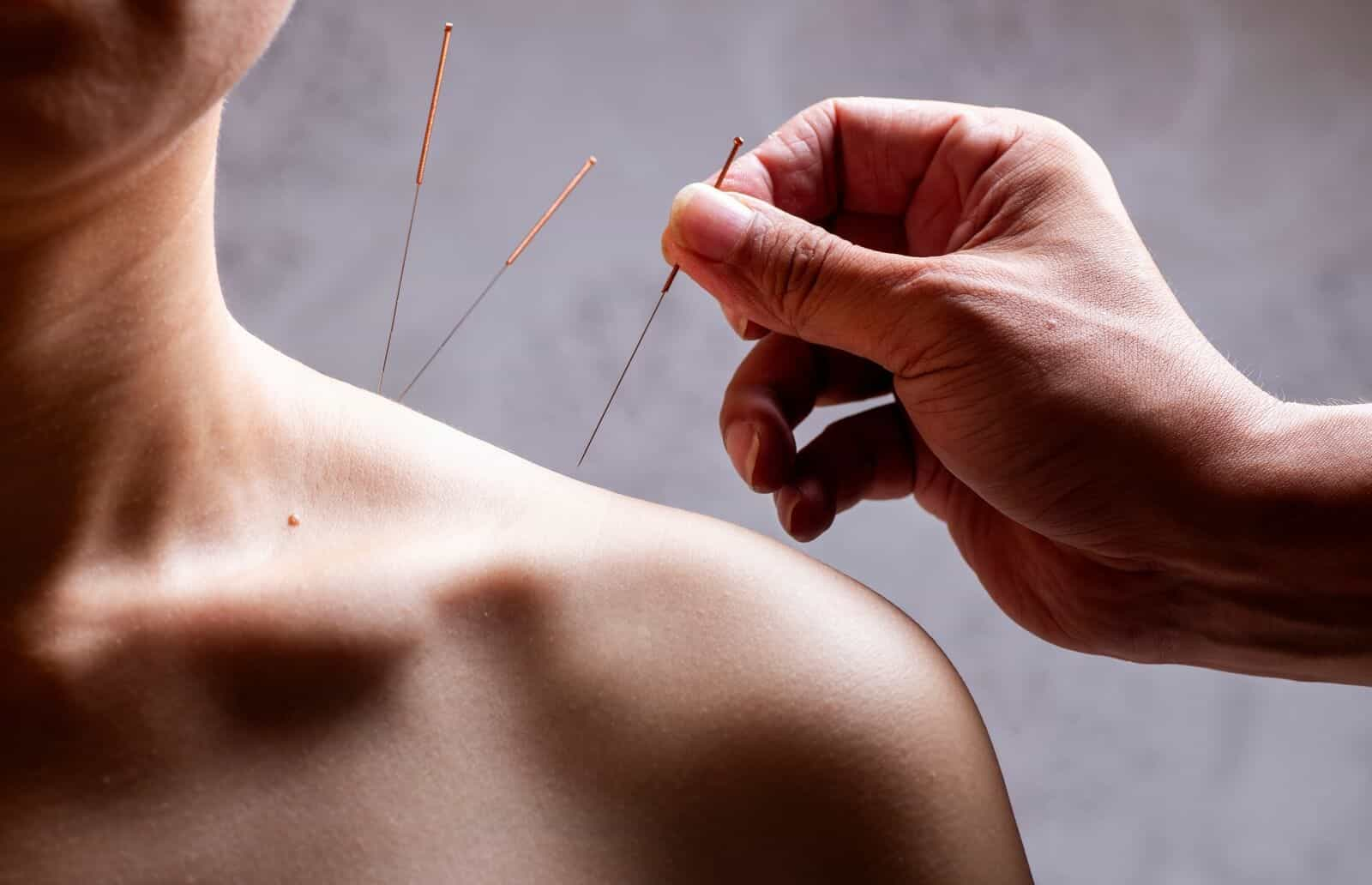 Acupuncture